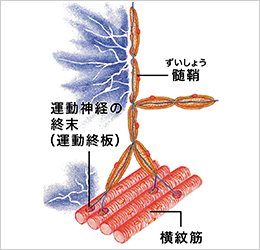 髄鞘が傷つき痛みが出るイメージ図
