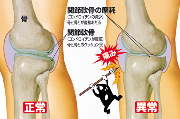 関節軟骨の摩耗による痛みが出るイメージ図