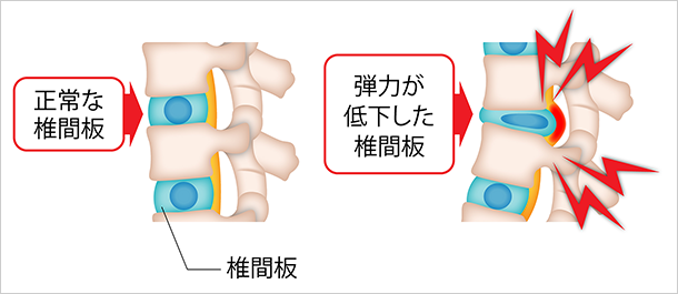 椎間板の弾力が低下し痛みが出るイメージ図
