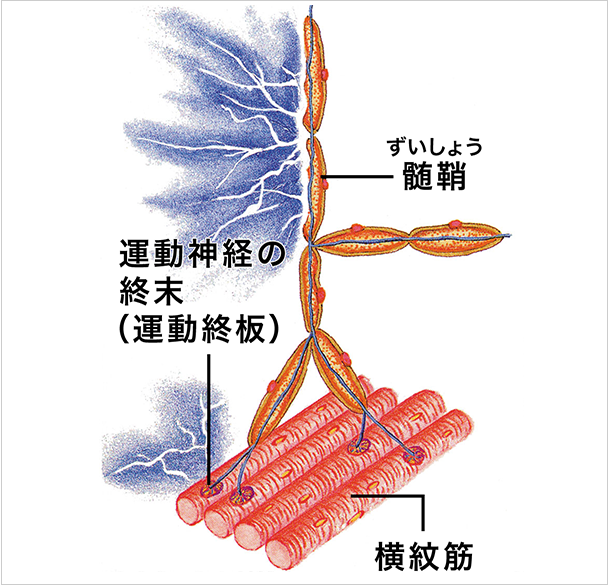 髄鞘が傷つき痛みが出るイメージ図