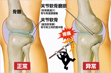 関節軟骨の摩耗による痛みが出るイメージ図