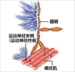 髄鞘が傷つき痛みが出るイメージ図