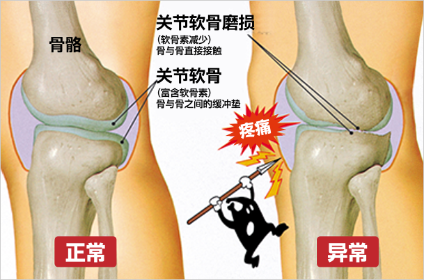 関節軟骨の摩耗による痛みが出るイメージ図