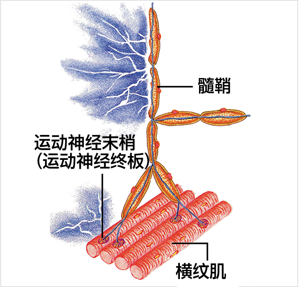 髄鞘が傷つき痛みが出るイメージ図