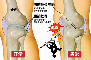 関節軟骨の摩耗による痛みが出るイメージ図
