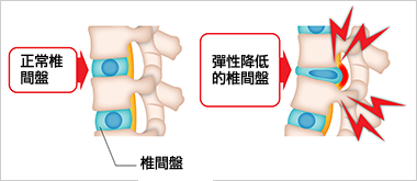 椎間板の弾力が低下し痛みが出るイメージ図