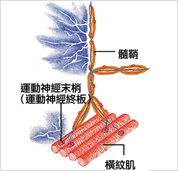 髄鞘が傷つき痛みが出るイメージ図