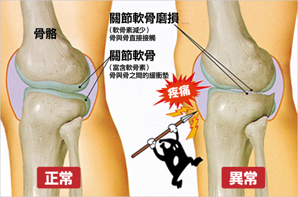関節軟骨の摩耗による痛みが出るイメージ図