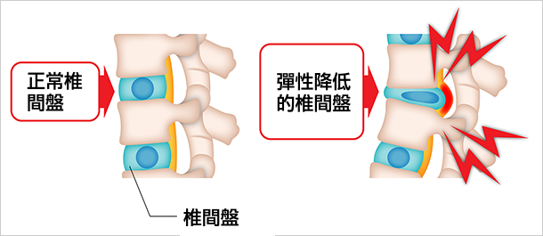 椎間板の弾力が低下し痛みが出るイメージ図