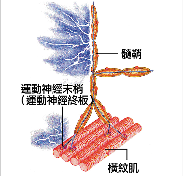 髄鞘が傷つき痛みが出るイメージ図